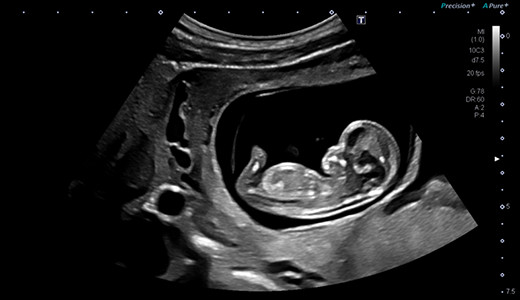 胎児11週