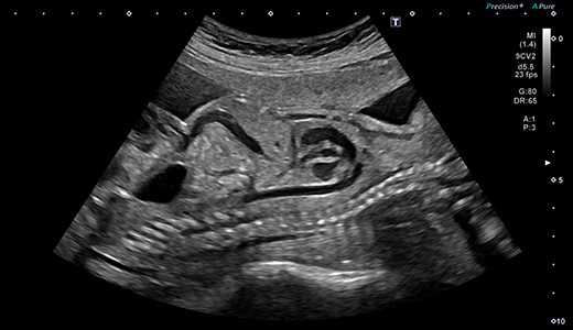 胎児23週