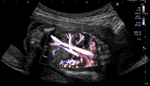 cSMI 胎児腹部