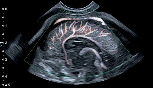 cSMI 胎児頭部