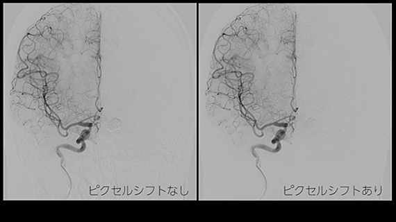 新画像処理コンセプト | 血管撮影装置 | Angiography | IVR