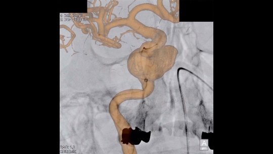 Alphenix Workstation | 血管撮影装置 | Angiography | IVR