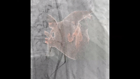 Alphenix Workstation | 血管撮影装置 | Angiography | IVR